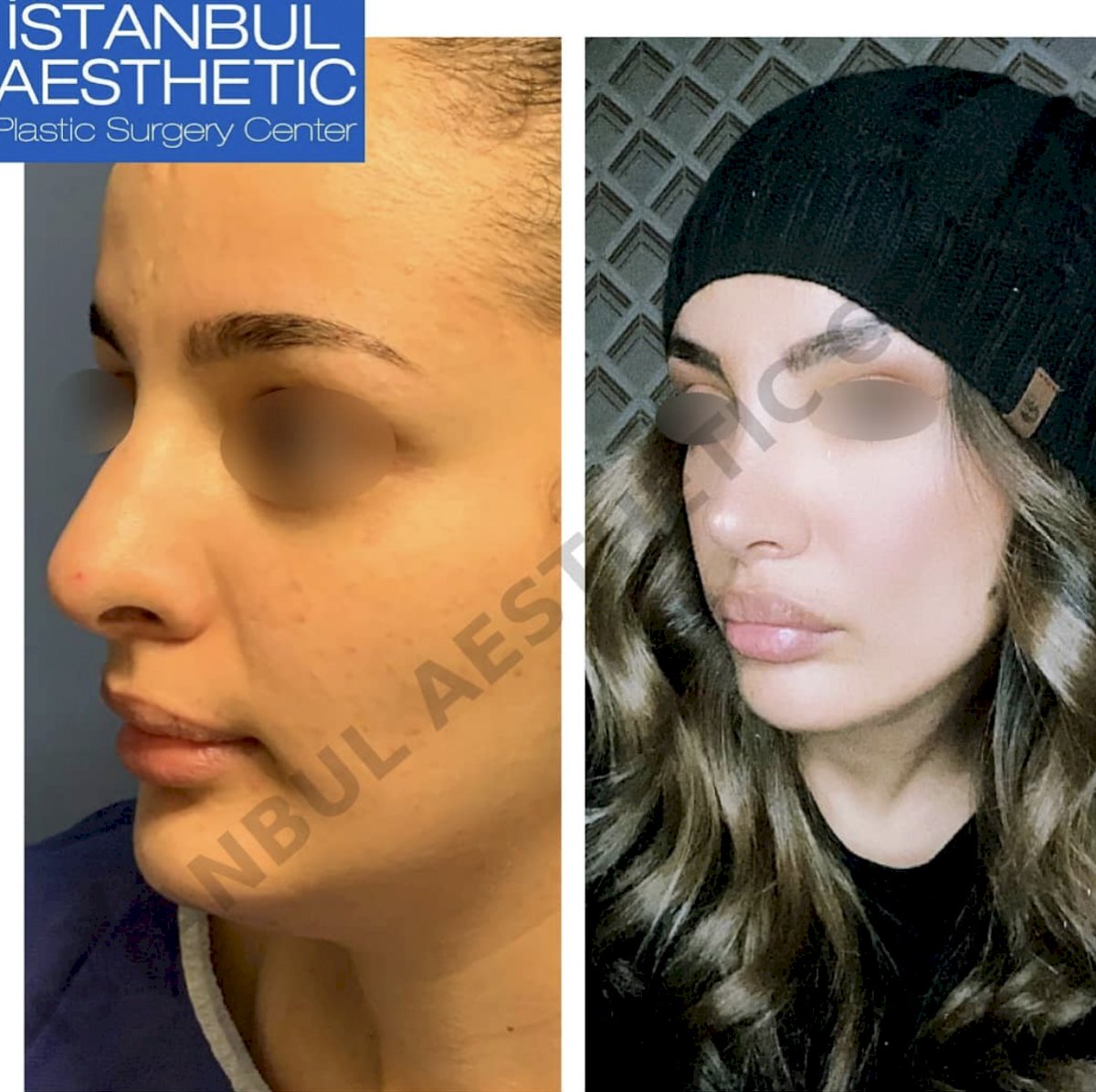 Istanbul Aesthetic Plastic Surgery Center in Turkey 154 reviews