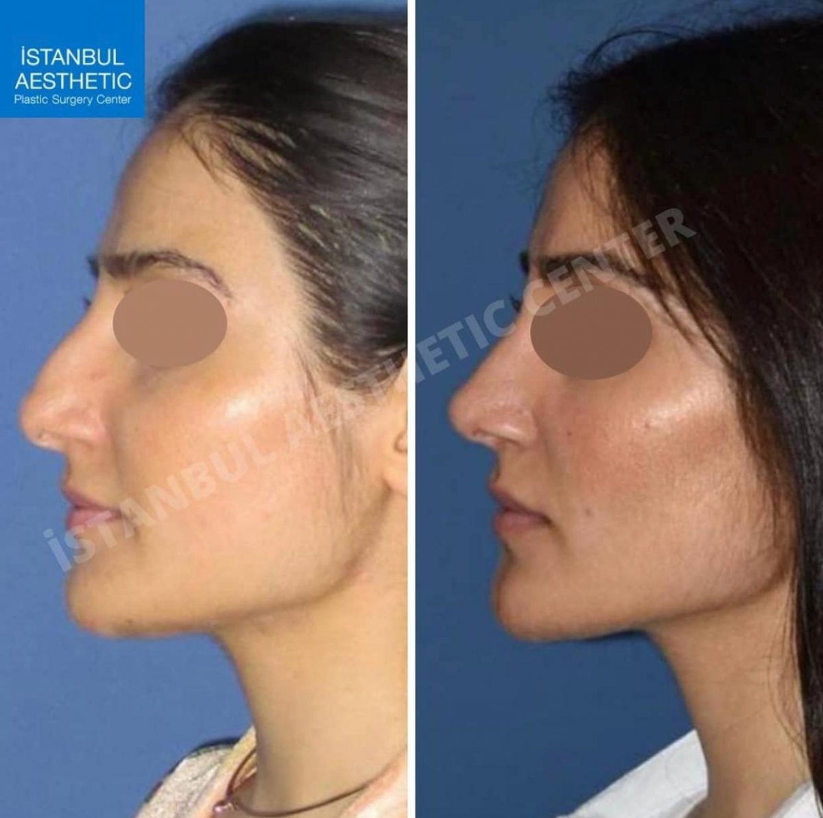 Istanbul Aesthetic Plastic Surgery Center in Turkey 150 reviews