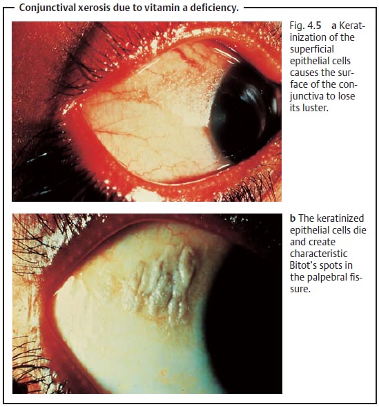 Conjunctival Degeneration and Aging Changes