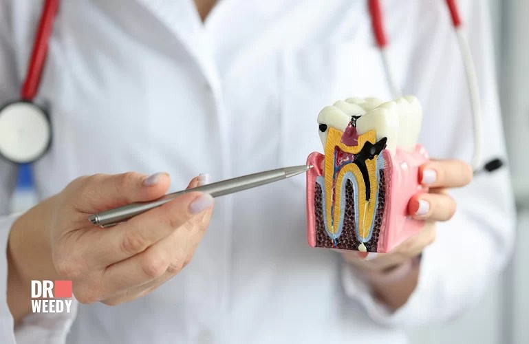 Can You Smoke Weed After Wisdom Teeth Surgery?