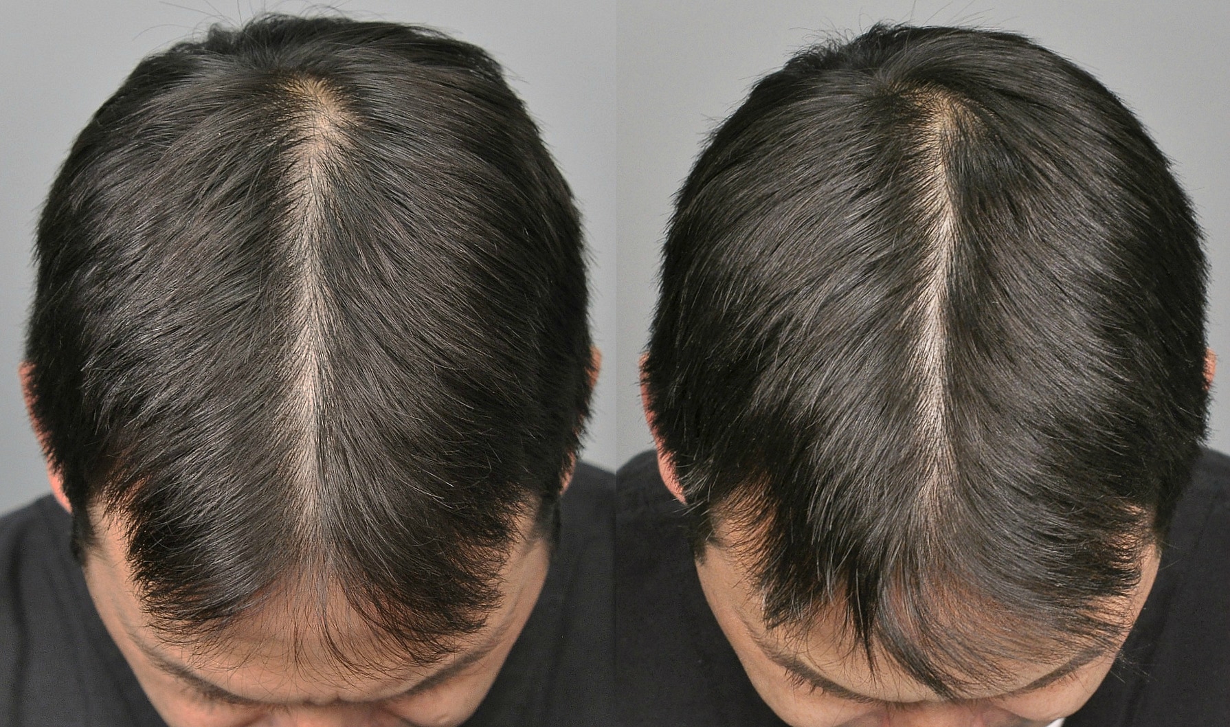 PRP Therapy For Hair Loss New Treatment Shows Promise
