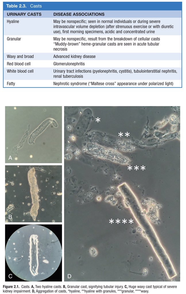 Hyaline Cast In Urine