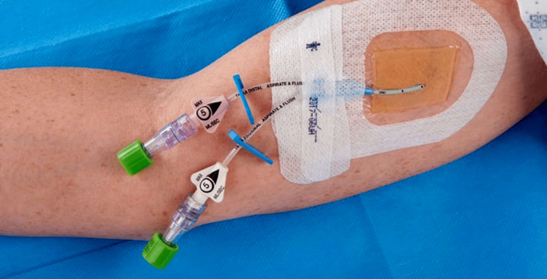 Cathetercare trifecta compliant, costeffective, innovative