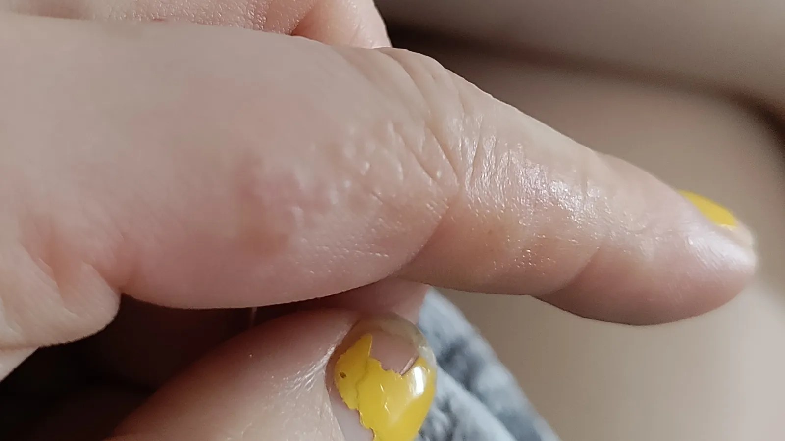 So THAT's What Those Tiny Itchy Bumps On Your Fingers Are