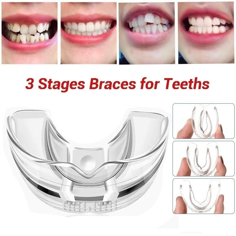 What Are The Stages Of Braces slidesharetrick