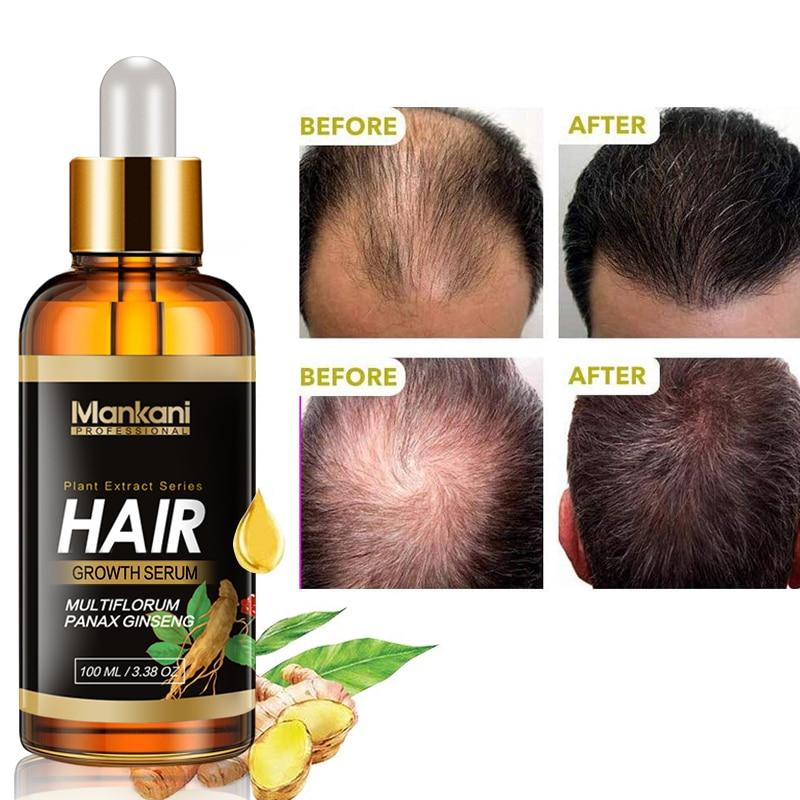 Details more than 74 minoxidil hair oil latest in.eteachers
