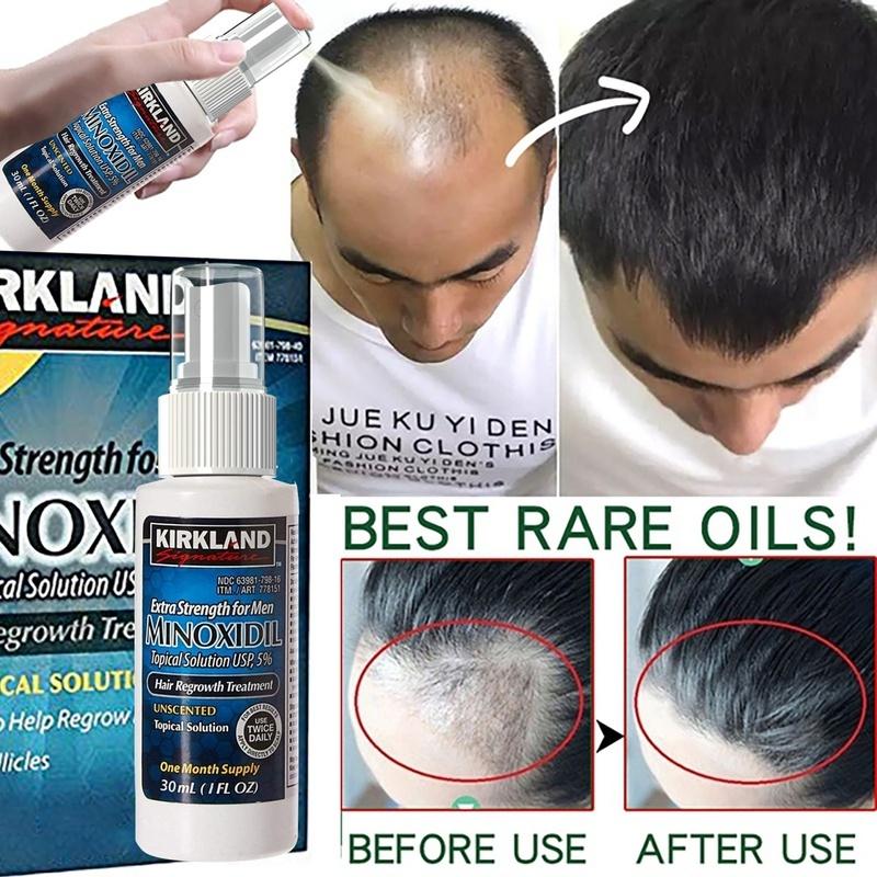 Buy Minoxidil5 Extra Strength Hair Regrowth Preventing Hair Loss