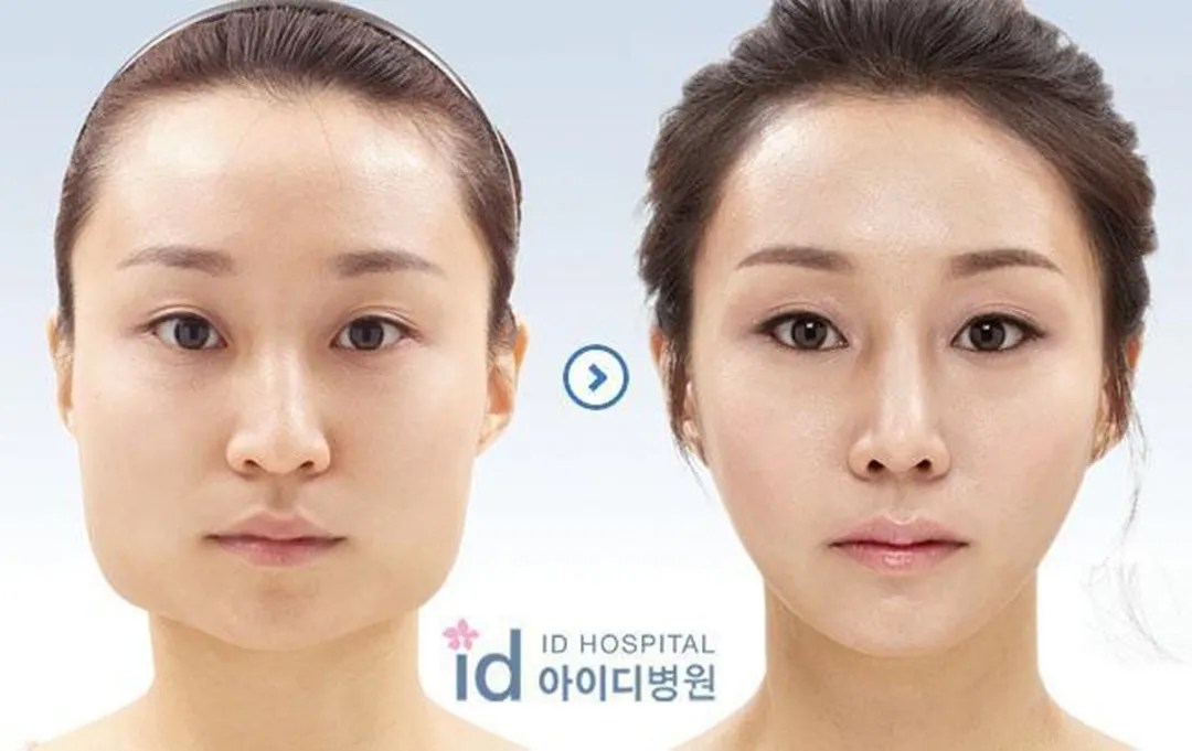 Plastic Surgery Procedures in Asian and Western Countries Show Contrast