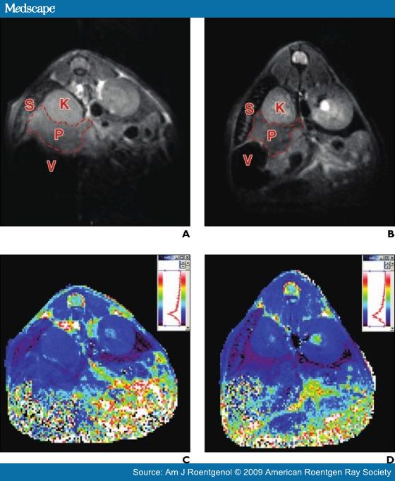 MRI in Diabetes First Results