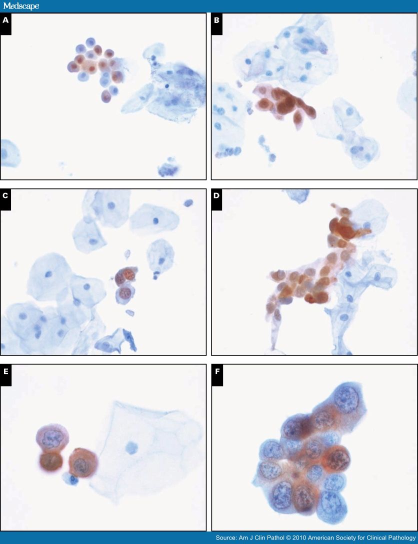 low grade squamous intraepithelial lesion mild dysplasia danyalsak