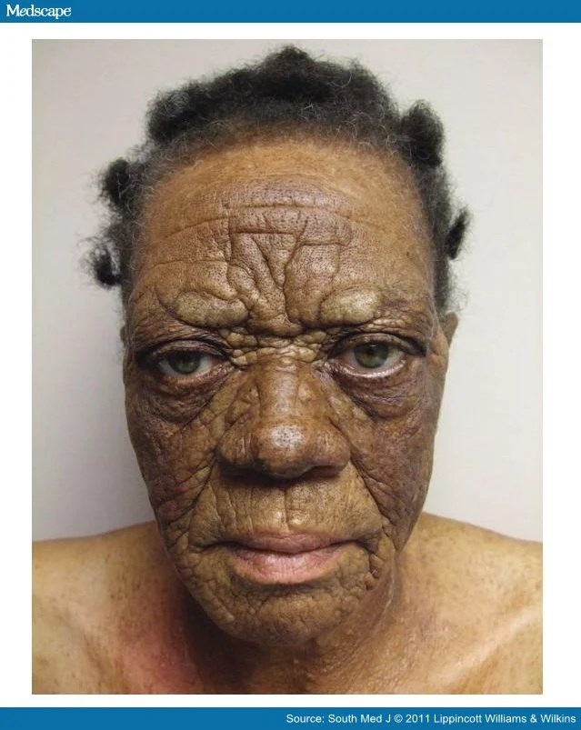 MastocytosisAssociated Leonine Facies and Eyebrow Loss