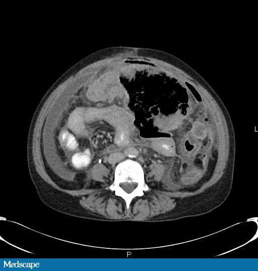 Constipation, Abdominal Pain, and a Strong Family History