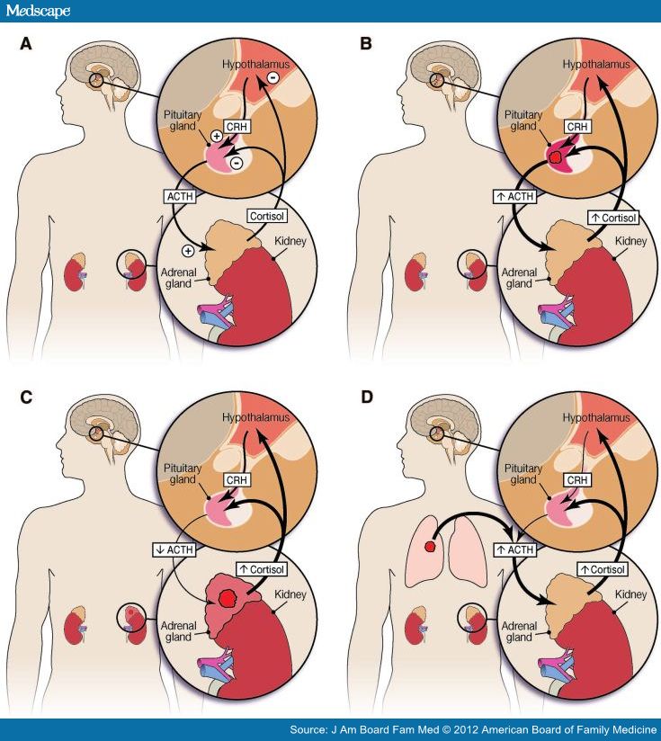 Cushing Syndrome Maybe Not So of a Disease