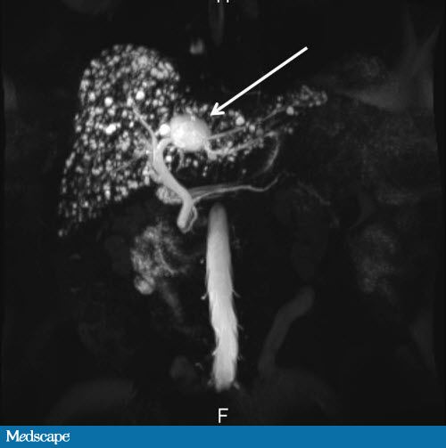Caroli Disease When Your Ducts Aren't in a Row