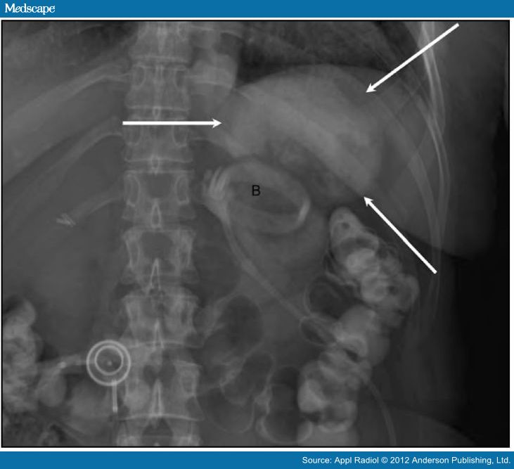 Imaging Findings in Bariatric Surgery