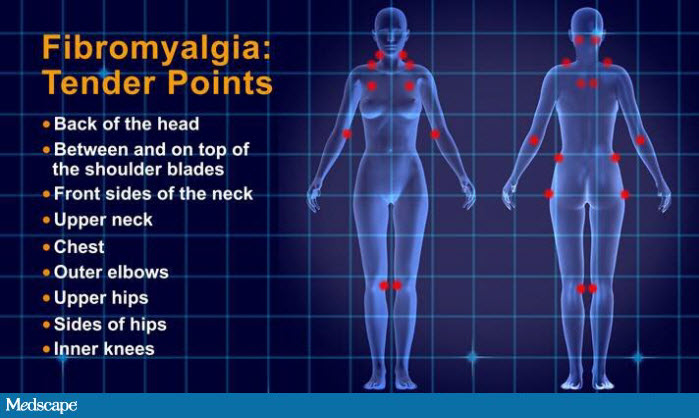 [DIAGRAM] Symptoms Fibromyalgia Trigger Point Diagram - WIRINGSCHEMA.COM