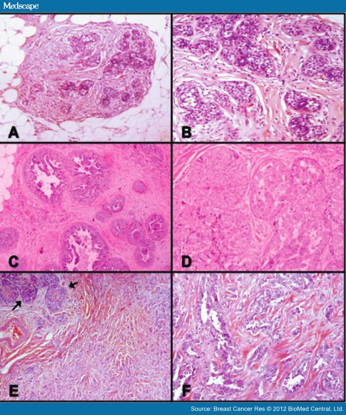 Episode 22: Invasive lobular carcinoma Breast Cancer.