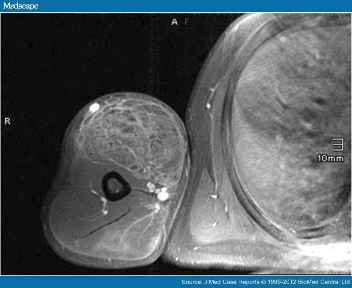 Muscle Fibrosis Following Synthol Injections in a Bodybuilder