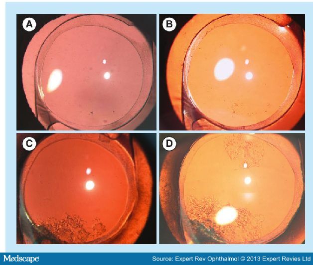 Posterior Capsule Opacification After Lens Implantation