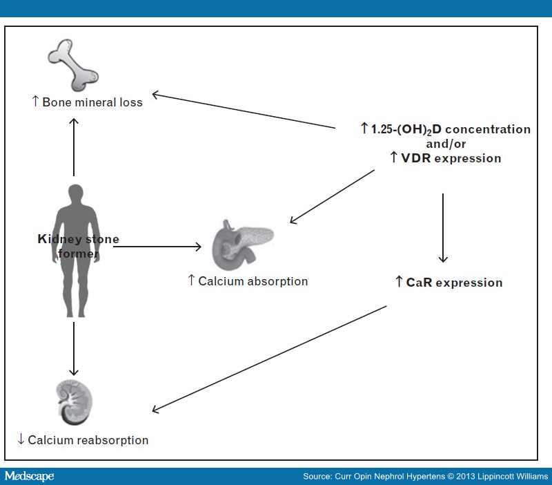 Vitamin D and Kidney Stone Disease