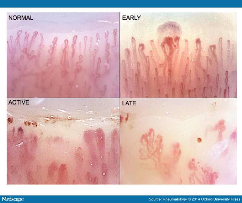 State of the Art on Nailfold Capillaroscopy