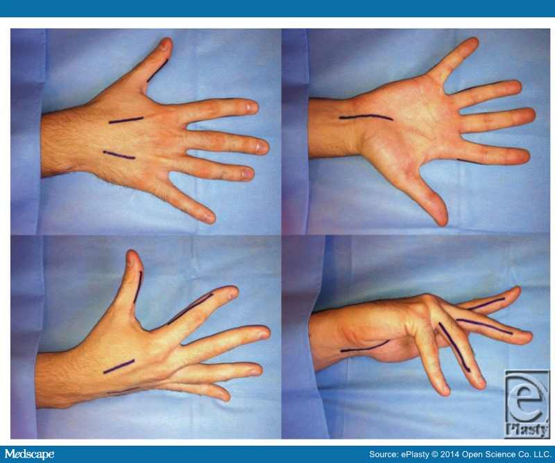 Compartment Syndrome of the Hand
