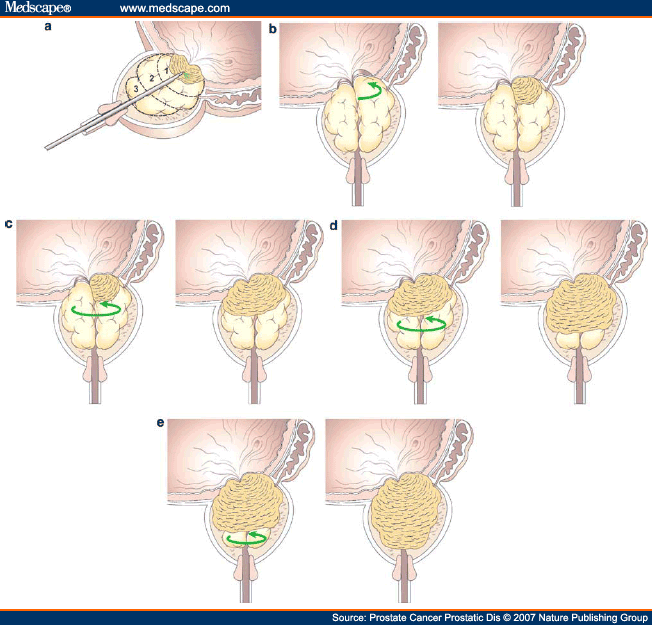 Photoselective Vaporization of the Prostate (GreenLight PV)
