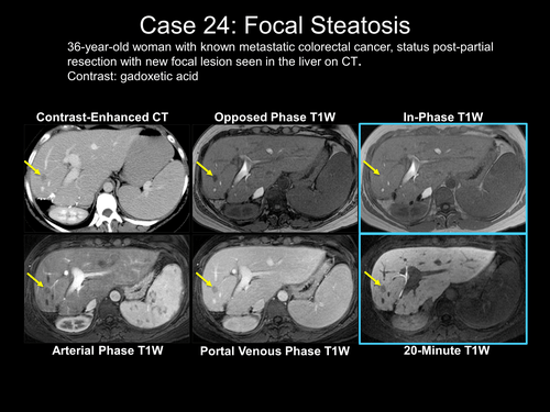 Liver Imaging with MRI