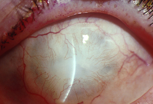 Ocular Emergencies Can'tMiss Acute Conditions