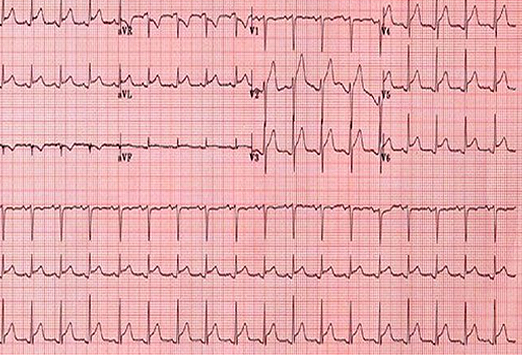 A Worrisome ECG Demanding Timely Action Case Quiz