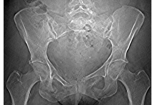 The Shattered Pelvis Slideshow