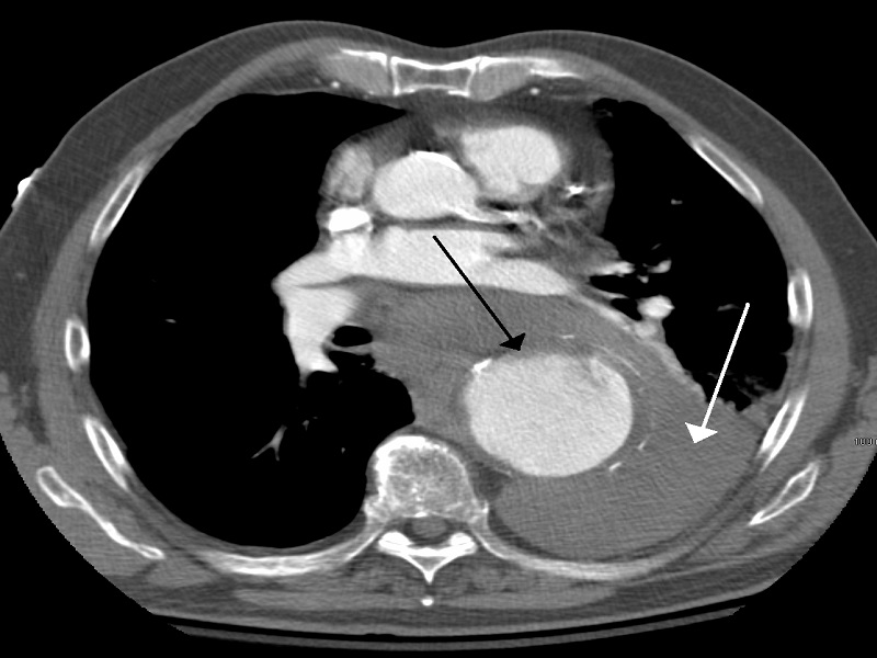 A 55YearOld Man With Severe Chest Pain USMLE Question