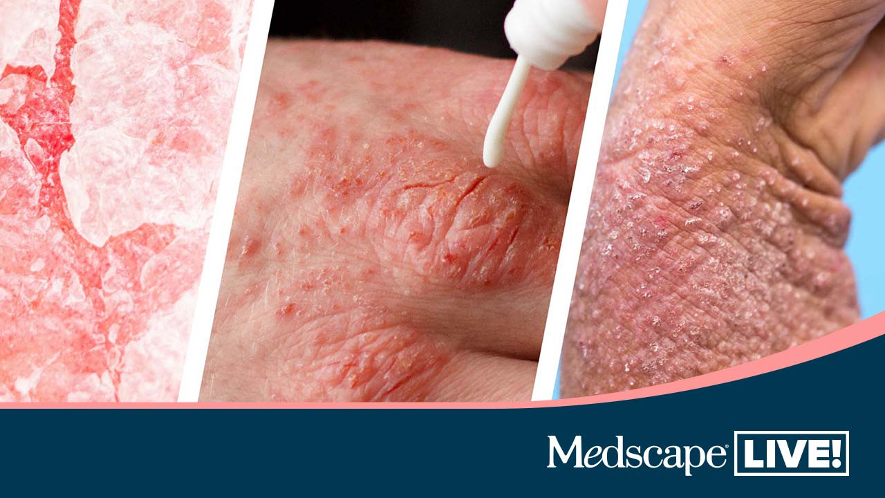 Exploring Emerging Topical Treatments in Psoriasis Are You Up to Date?