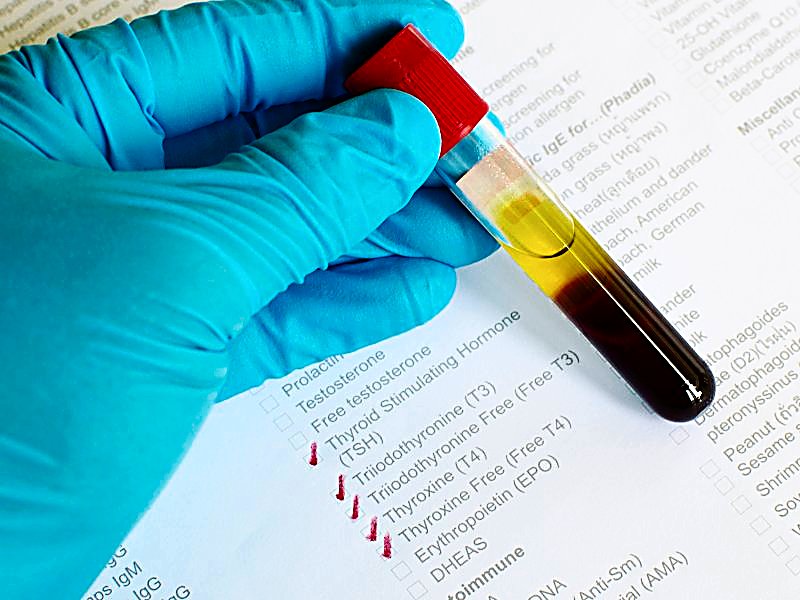 Mildly Elevated Thyroxine Levels Linked to SCD