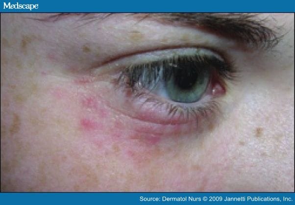 Periorbital Dermatitis It's Not Every Rash That Occurs