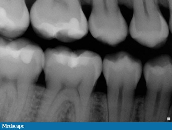 New Techniques for Early Caries Intervention Two Cases