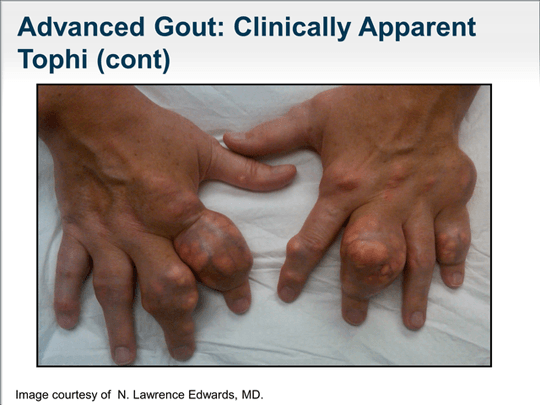 Managing Patients with Chronic Gout A Multidisciplinary Approach to