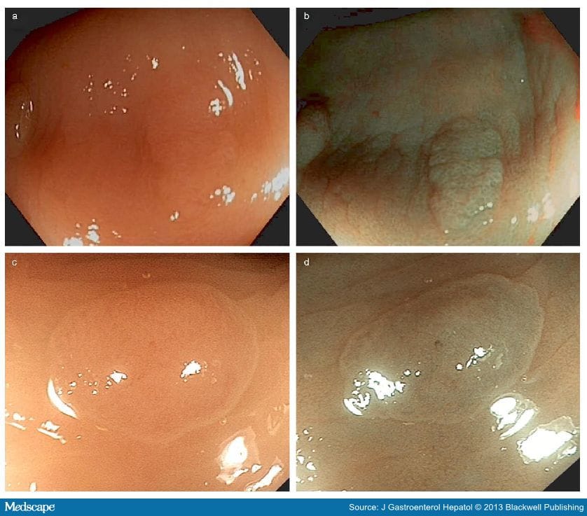 NBI vs White Light Endoscopy to Assess Colorectal Polyps