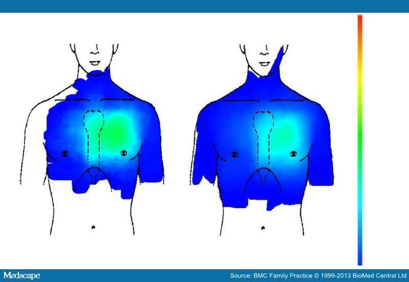 Chest Pain Is the Location of Pain Diagnostically Helpful? Page 4