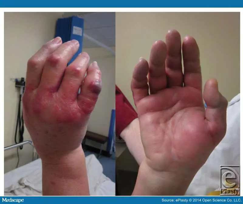 Compartment Syndrome of the Hand