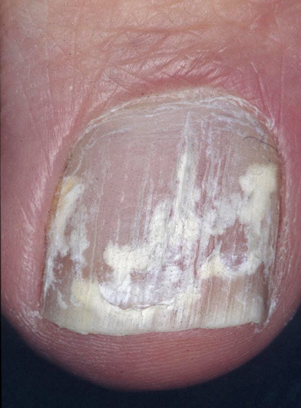 Effective Treatment of Onychomycosis