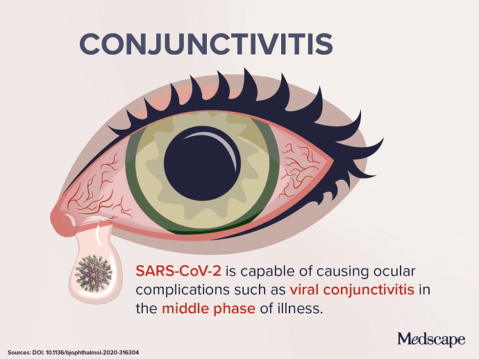 Trending Clinical Topic Conjunctivitis