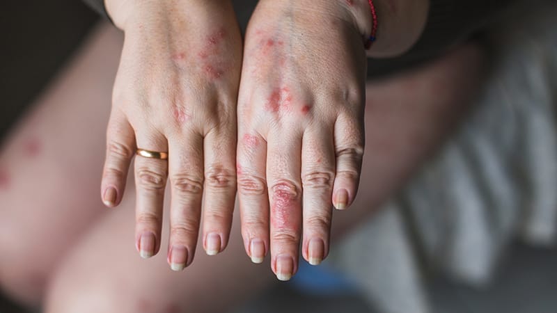 Maladies inflammatoires chroniques un risque CV variable d’une