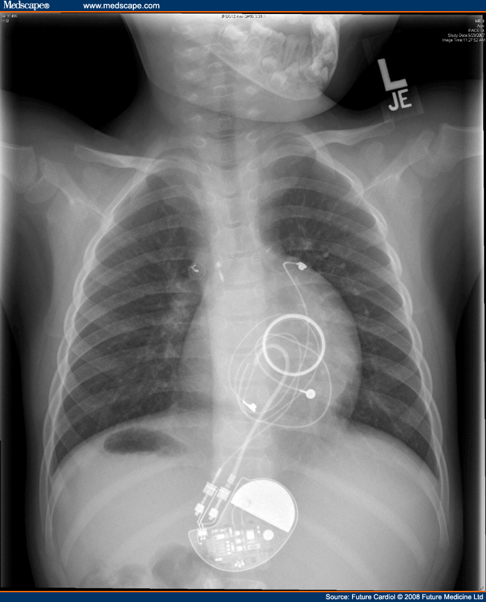Pacemaker and Defibrillator Therapy in Peds and Congenital
