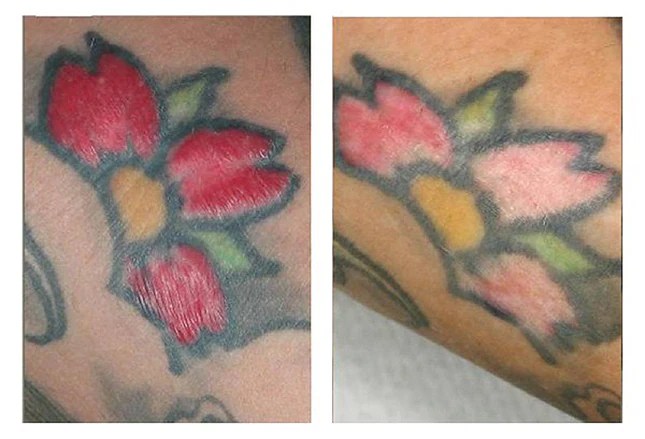 Tattoo Skin Reactions: Allergies And Infections 439_x_645_jpg
