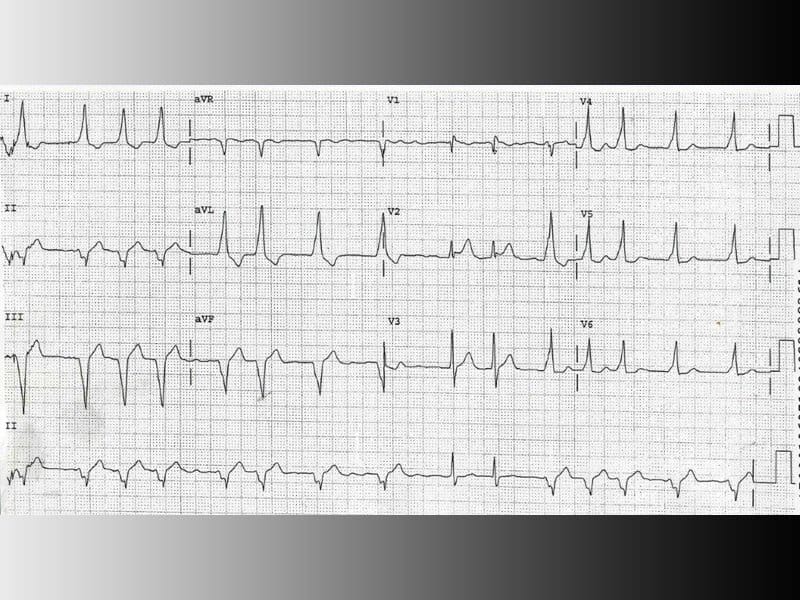 Desafio ECG palpitação de início súbito em uma mulher jovem