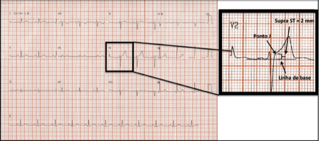 Quais os critérios eletrocardiográficos de infarto com