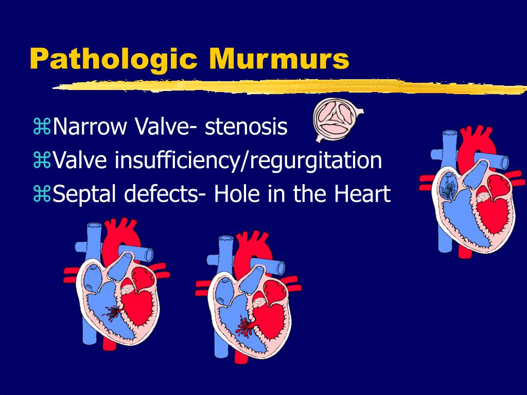 Pathologic Heart Murmurs Causes Symptoms And Treatment Steve Gallik
