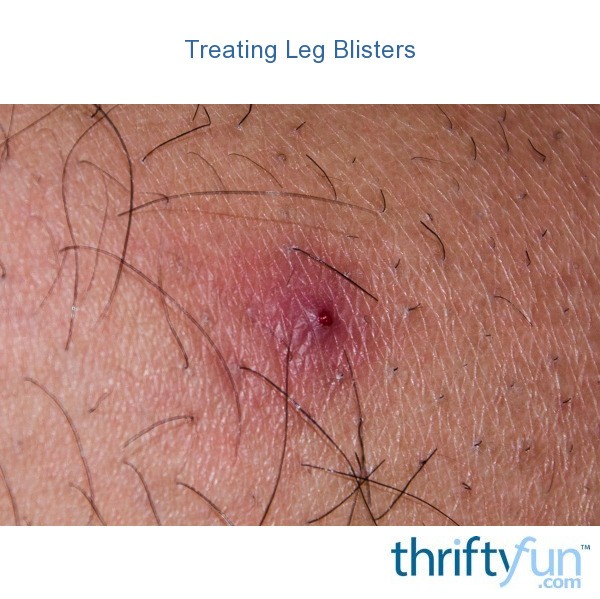 Treating Leg Blisters? ThriftyFun