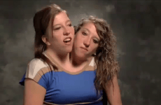 VIDEO Conjoined twins get their own reality TV show · The Daily Edge